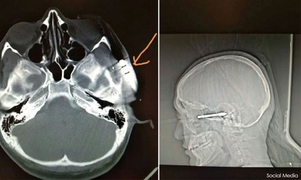 Arrow pierces student's face during archery training